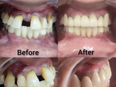 Visit Shantilila Dental Hospital for best dental checkup services